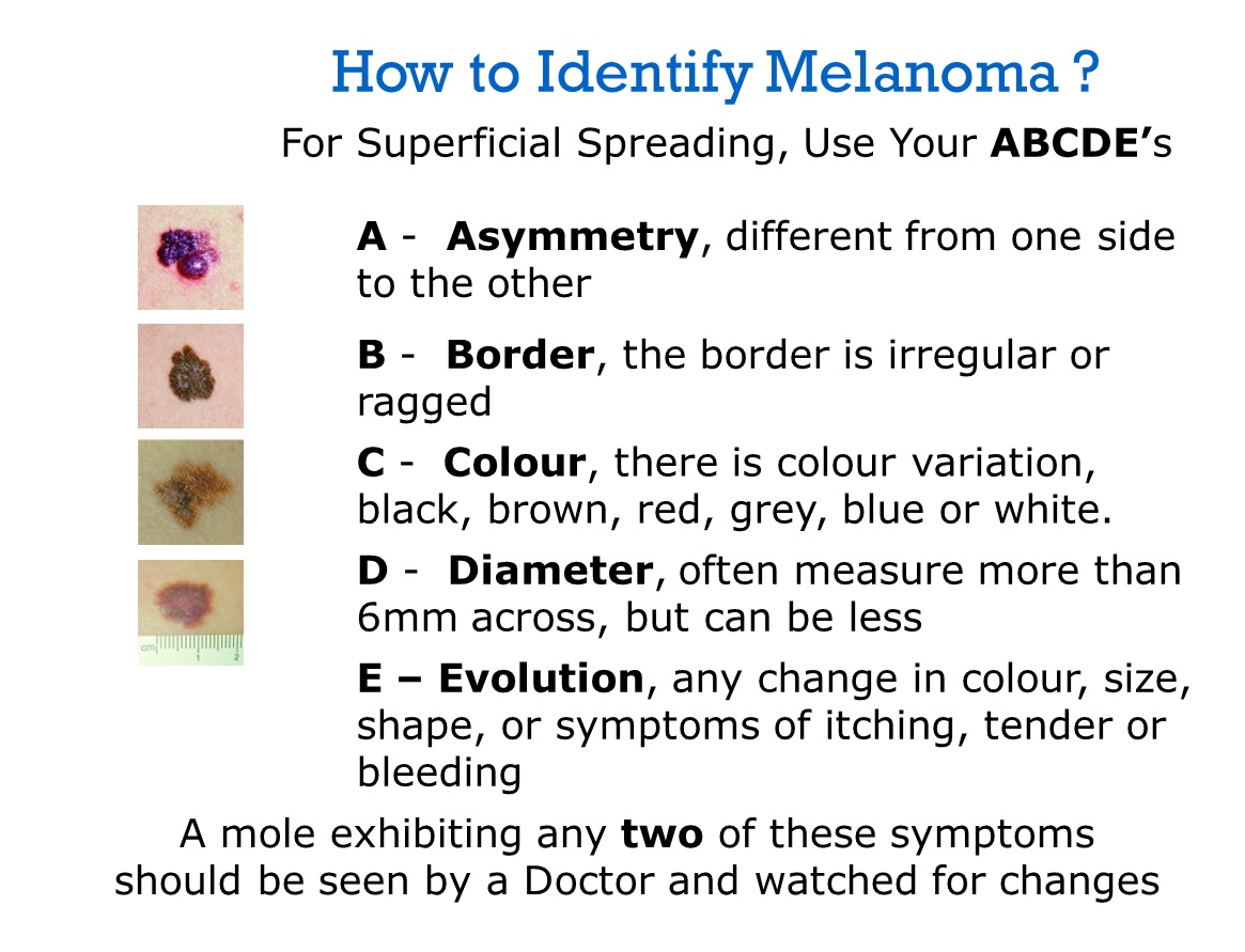 Mission "Melanoma" Melanoma Facts