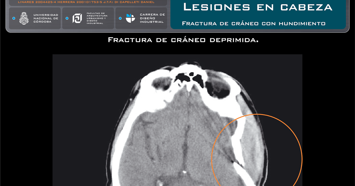 Volumen sanguíneo de lesiones en la cabeza