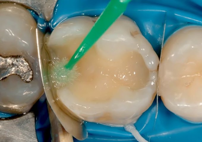 OPERATIVE DENTISTRY: Indirect Posterior Resin Composite Restorations - Clinical Case