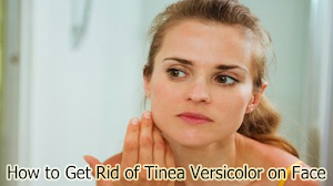 How to Get Rid of Tinea Versicolor on Face How to Get Rid of Tinea Versicolor on Face
