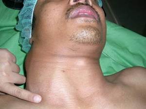 Obat Tumor Ganas Di Leher
