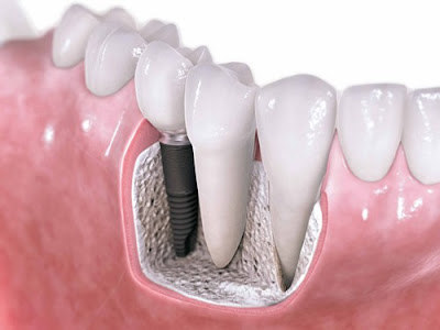 Trồng răng khi còn chân răng có được không?