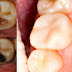 5 Tips on How to Reverse Cavities and Heal Tooth Decay Naturally at Home