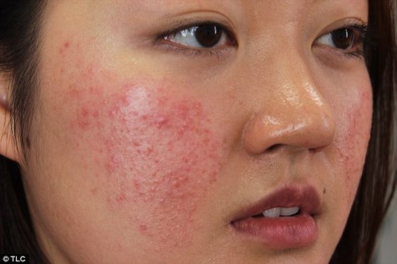 kem trị nám bán ở đâu HCM kem trị nám bán ở đâu HCM
