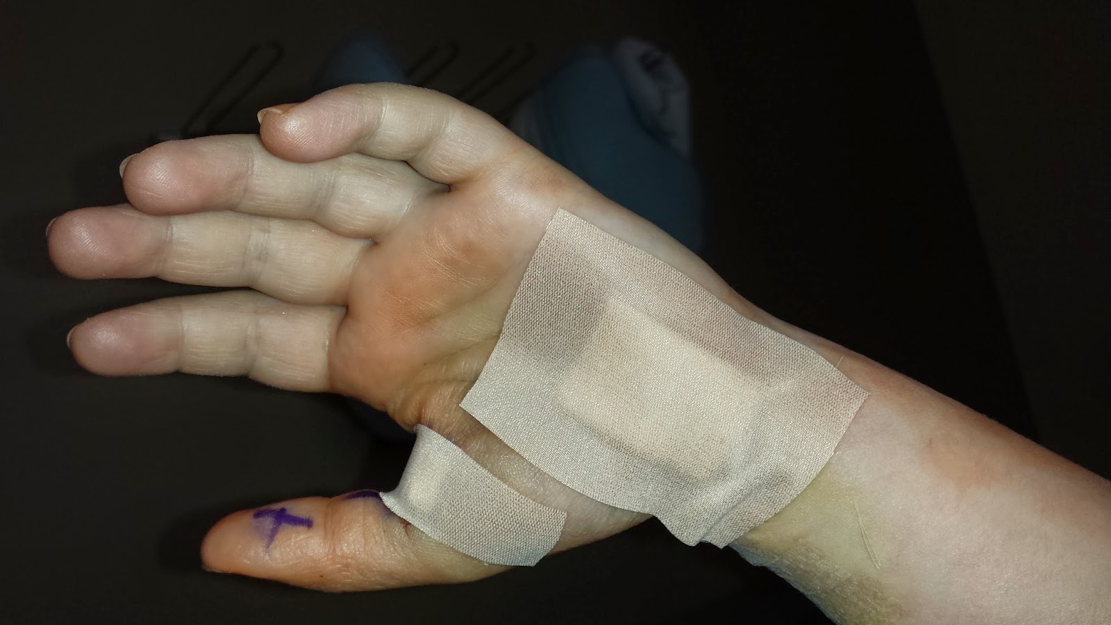 out of the lyme light Wrist surgery I have gory photos!