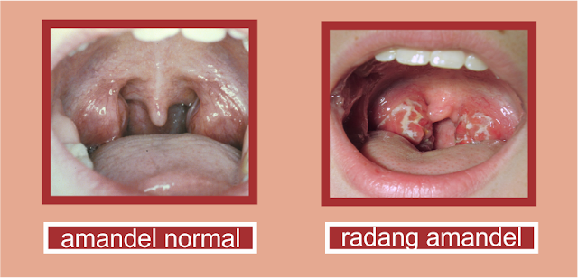 Perbedaan Radang Amandel dan Radang Tenggorokan Perbedaan Radang Amandel dan Radang Tenggorokan
