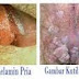 Obat Kutil Kelamin Langsung Sembuh thumbnail