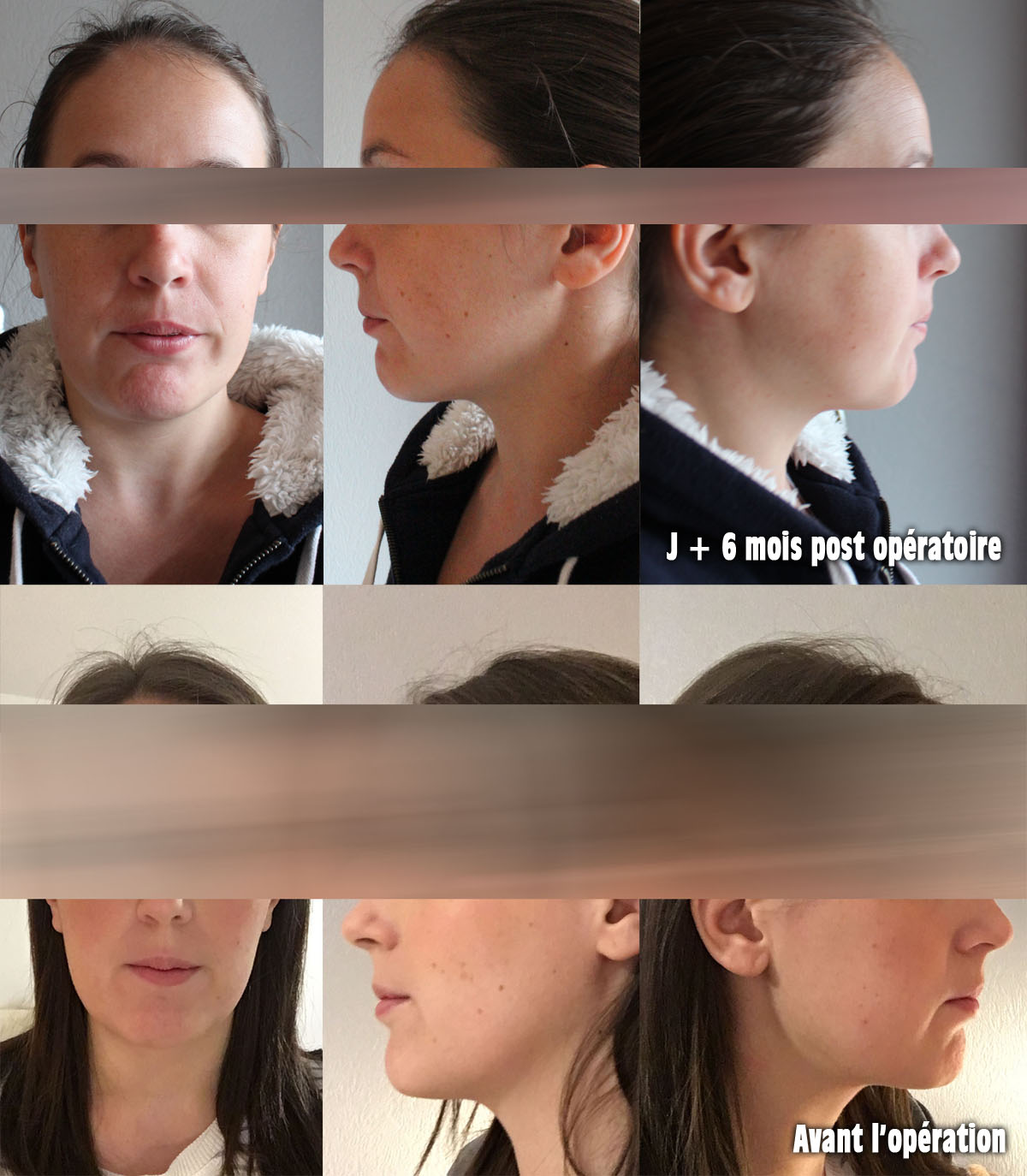 Orthodontie adulte bouche en chantier Opération d