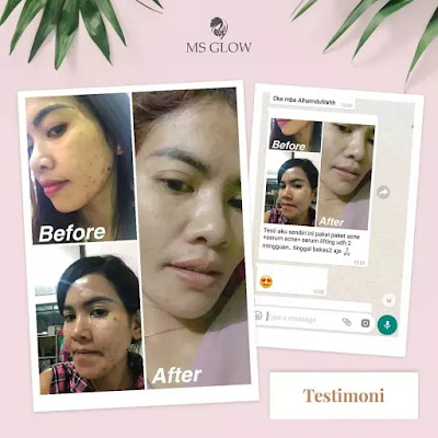 Ms Glow Acne Series Ms Glow Grosir Cikarang