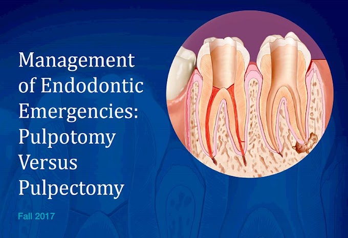 PDF: Management of Endodontic Emergencies: Pulpotomy Versus Pulpectomy
