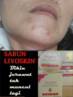 sabun penghilang jerawat dan bekasnya sabun penghilang jerawat dan bekasnya