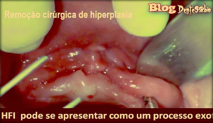 HIPERPLASIA PROTÉTICA: Remoção cirúrgica - Caso Clínico