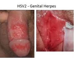 Foto Obat herpes genetalia