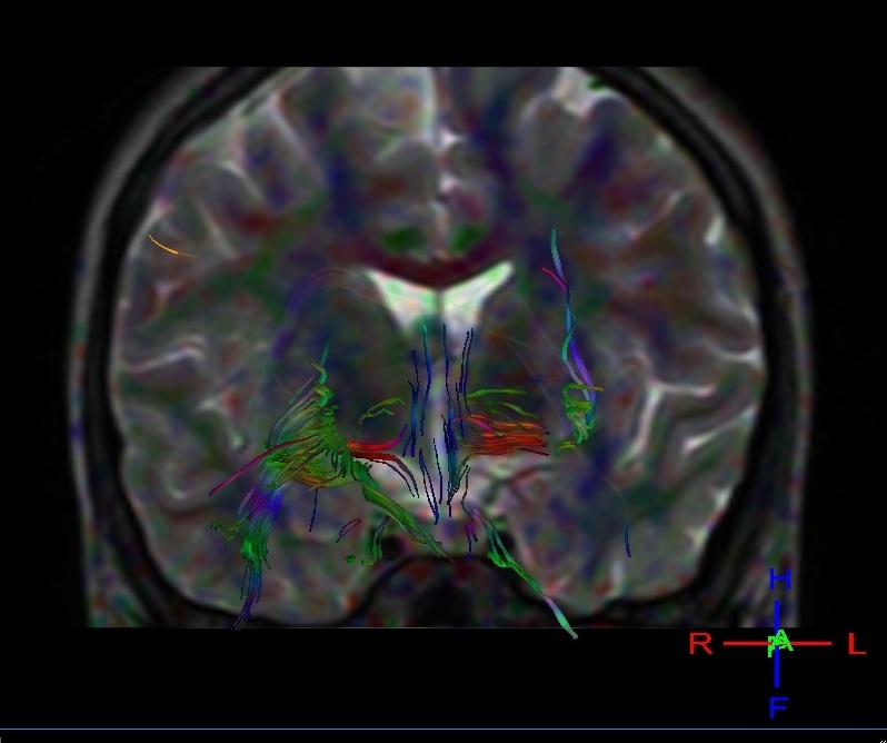 Leber's Optic Atrophy-DTI - Radiology Imaging