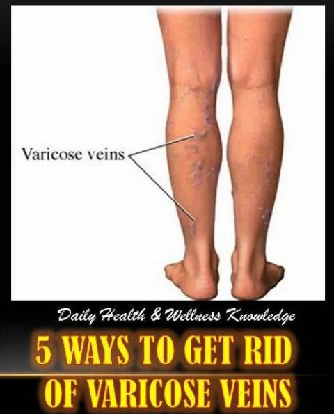Beautiful Get Rid Varicose Veins Design for Mobile
