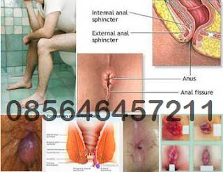 Susah BAB, Wasir (Hemoroid) dan AmbeJOSS Susah BAB, Wasir (Hemoroid) dan AmbeJOSS