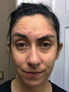 2 Weeks on Tretinoin – 6 Month Review :: The Acne Experiment