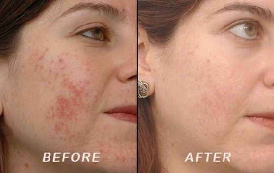 How to Remove Pimple Marks And Acne Marks From Face?