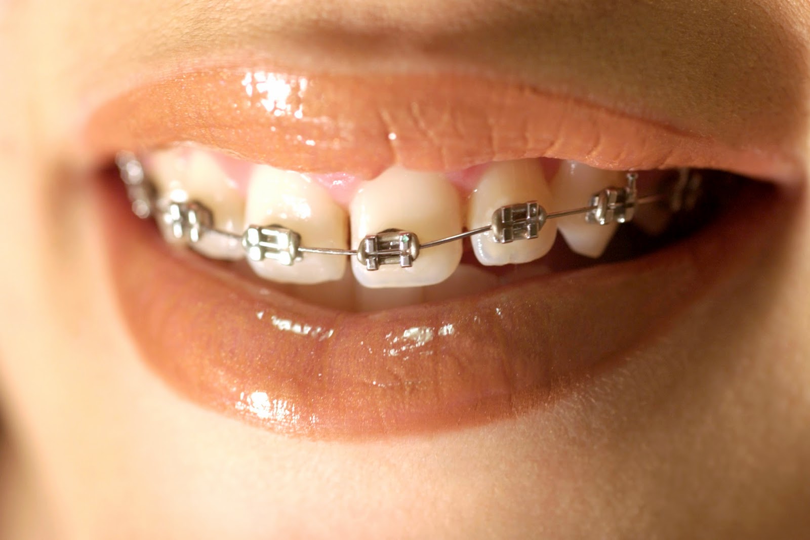 Examples of orthodontic appliances