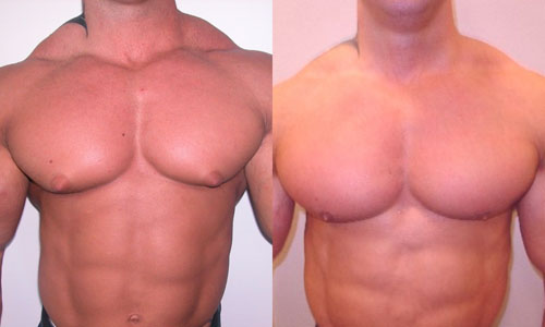 Отечность груди. Нормальная мужская грудь. Мужская грудь до и после. Асимметрия грудных мышц. Асимметрия грудных мышц у мужчин.