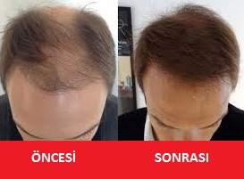 saç ekiminden önce ve sonra fotoğraflar