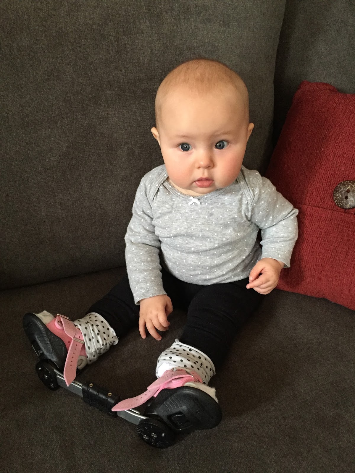 Clubfoot Brace DTKAFO Journeys N's Progress Updates