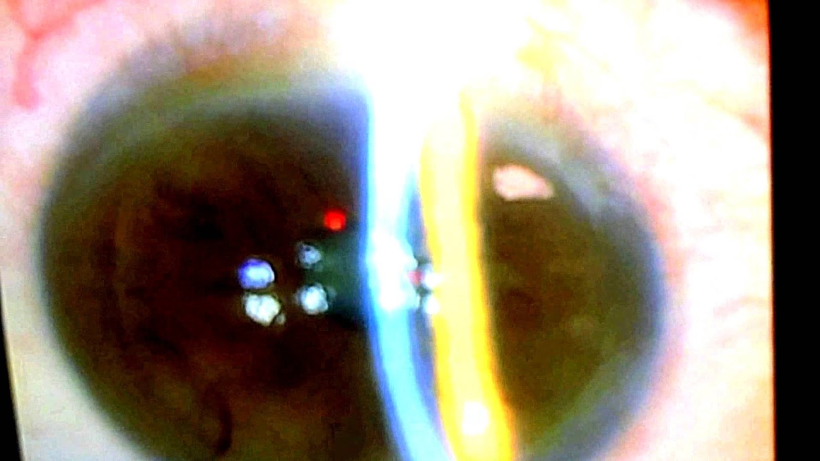 Laser blended vision Review Review Choices