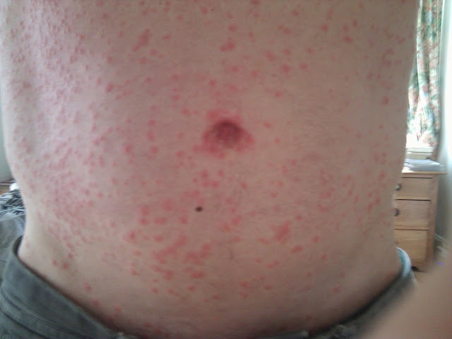 Sintoimas del virus zika virus_zika_sintomas_microcefalia