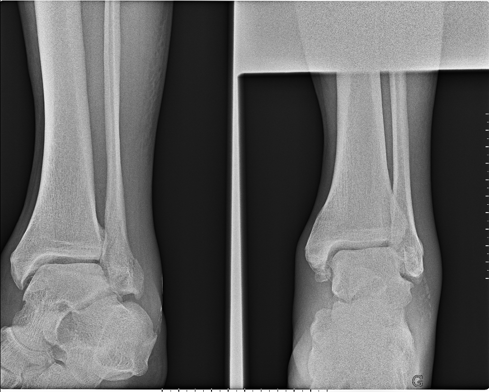 Fracture de la malléole externe sans déplacement