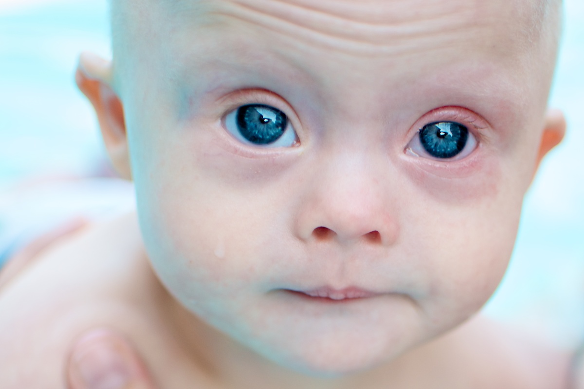 Белки глаз новорожденного. Брушфильда пятна брушфильда. Эпикантус синдром Дауна. Глаза у новорожденных.