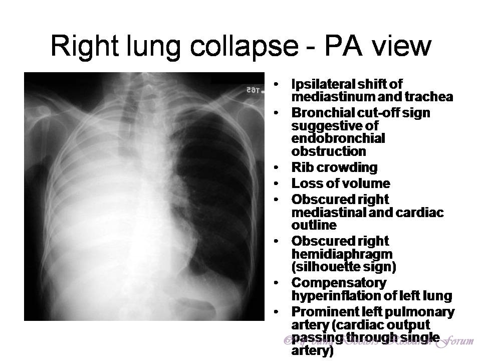 Advanced tracheal collapse