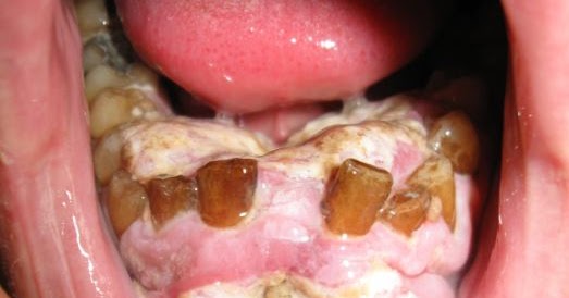 Dentosphere : World of Dentistry: MCQs on Benign and Malignant Tumors