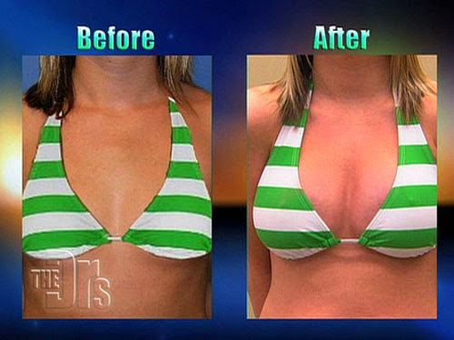 Breast lift surgery is the aesthetic surgery that improves the appearance a...