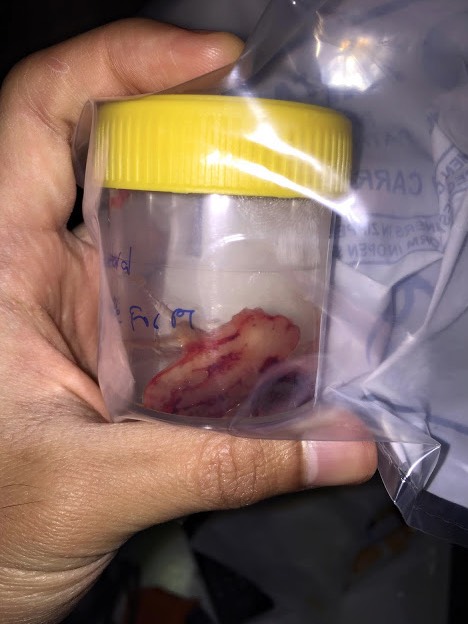 Biarpun Sudah 5 Tahun Berhenti Merokok, Hidung Lelaki Ini Masih Terpaksa Dibedah Biarpun Sudah 5 Tahun Berhenti Merokok, Hidung Lelaki Ini Masih Terpaksa Dibedah