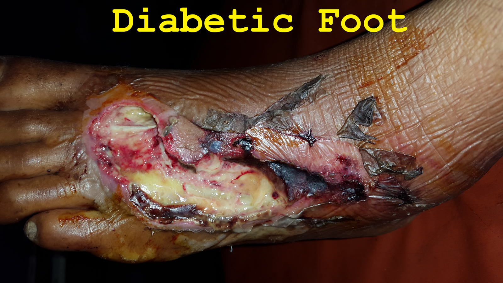 Diabetic Foot Infection: A Major and Dangerous Complication of Diabetes