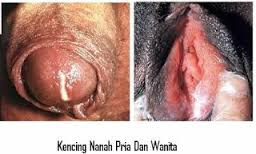 HEBOHH..!!! Inilah Pengobatan Kencing Nanah Atau Gonore Yang Ampuh