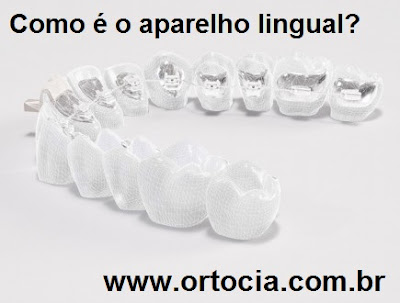 ortodontia lingual