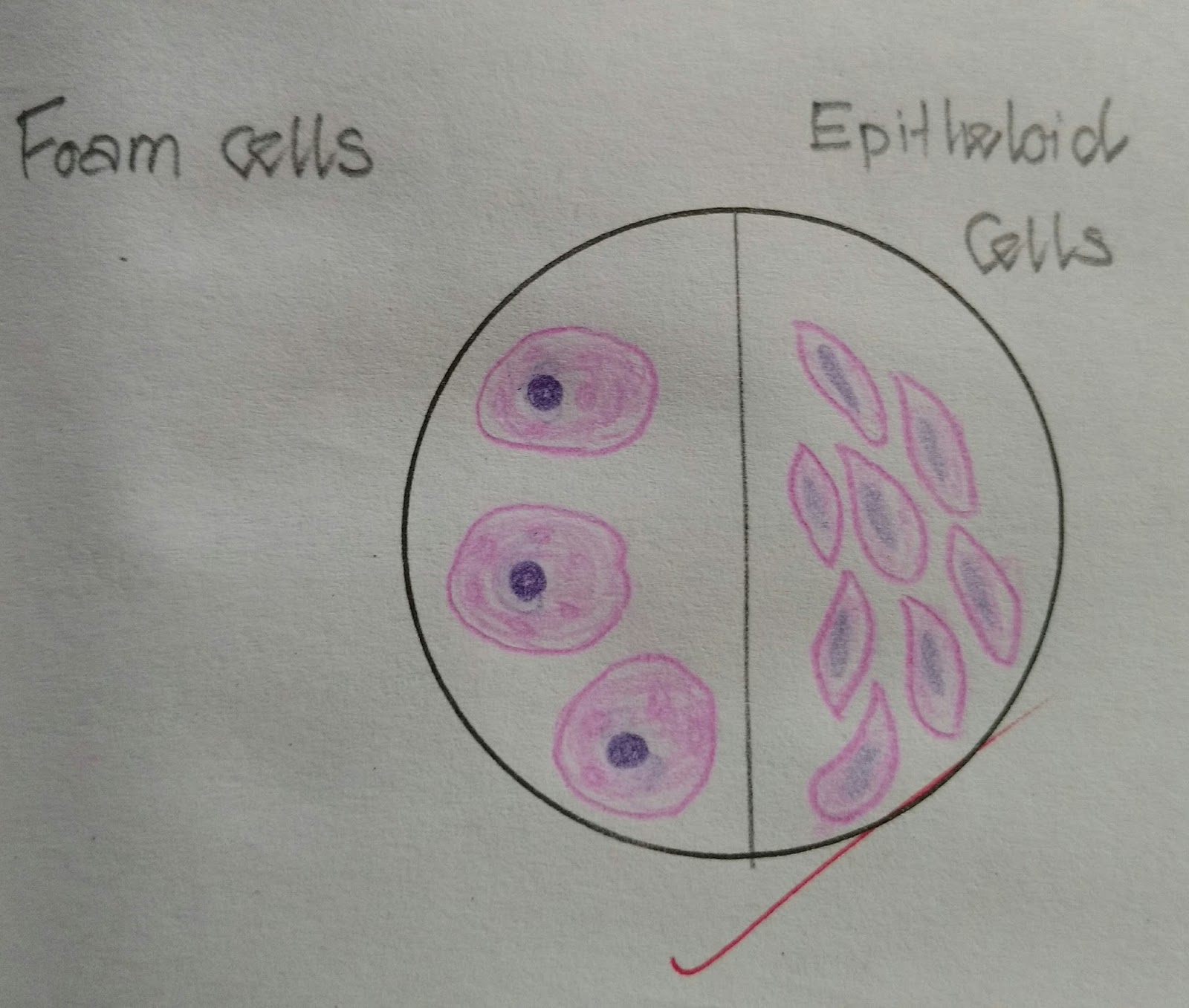Histopathology Drawings Foam cells and Epithelioid cells( note the