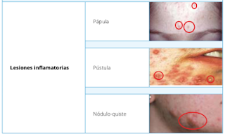 lesiones%2Binflamatorias%2Bacne%25CC%258
