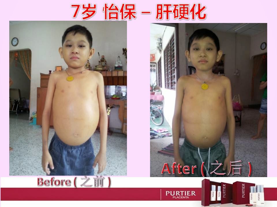 IPOH - 7 YEARS OLD - HARDENING OF LIVER