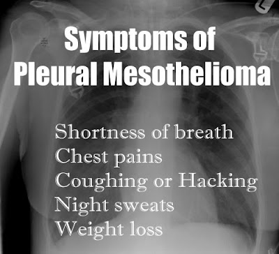 Symptoms of Pleural Mesothelioma of the Chest Symptoms of Pleural Mesothelioma of the Chest