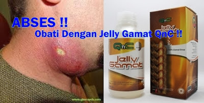 Obat Abses Kulit Terampuh : Abses Perianal, Abses Payudara, dll Obat Abses Kulit Terampuh : Abses Perianal, Abses Payudara, dll