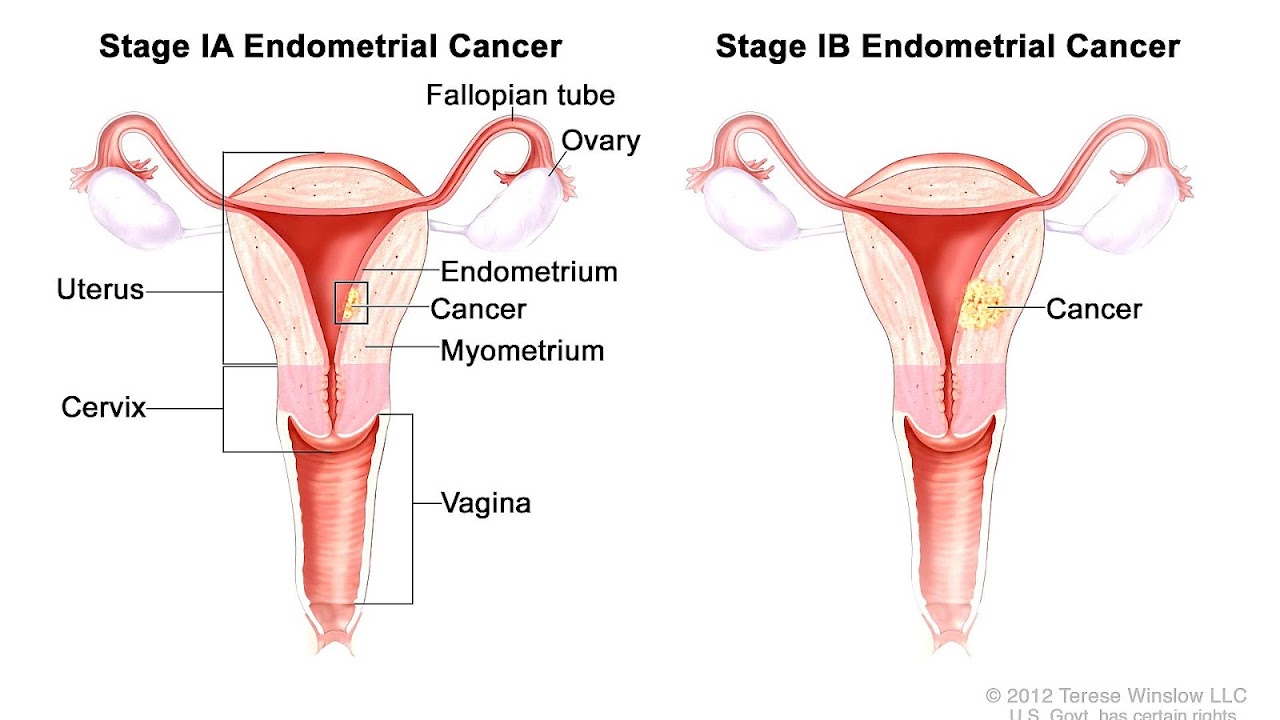 Endometrial Cancer Symptoms After Menopause Menopause Choices