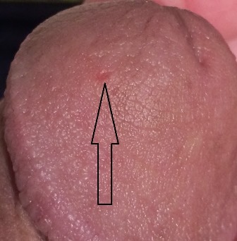 Museum Nylon Woman Bumps On The Penis Head