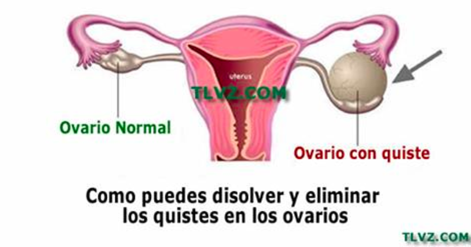 paquete de aceite de ricino para el dolor pélvico