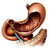 Gastroparesis Treatment, Cause And Remedies