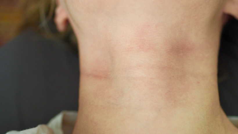 atopia, atopic skin, iho, Olympus OM-D E-M10