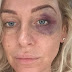 Top 4 Ways To Clear Up The Black Eye