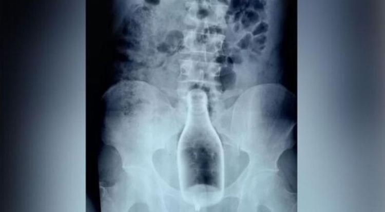 X-ray of liquor bottle in stomach