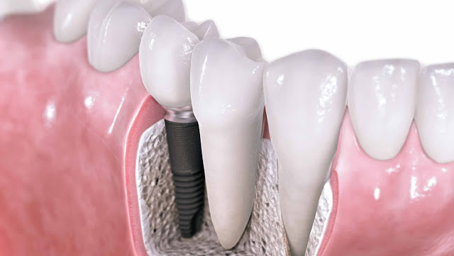 implante dentario marcelo borille